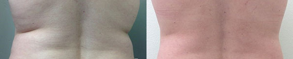 Trusculpt Before and After Photo by Dr. Wang in Los Angeles, CA