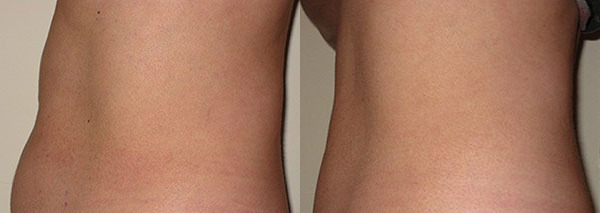 Trusculpt Before and After Photo by Dr. Wang in Los Angeles, CA