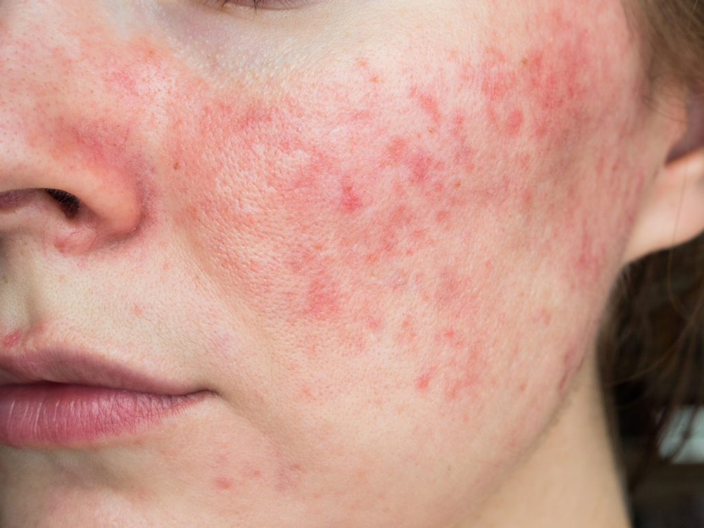 Rosacea Metropolis Dermatology Los Angeles