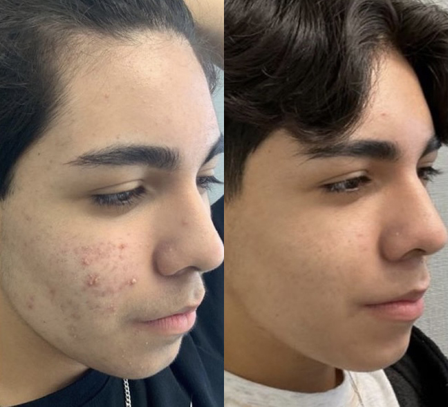 Acne Treatment Before and After Photo by Dr. James Y. Wang of Metropolis Dermatology in Los Angeles, CA