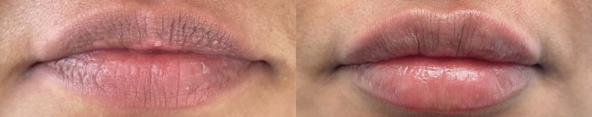 Lip Filler Before and After Photo by Dr. James Y. Wang of Metropolis Dermatology in Los Angeles, CA