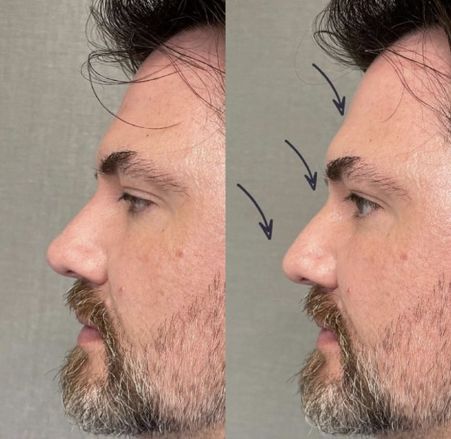 Liquid Rhinoplasty Before and After Photo by Dr. James Y. Wang of Metropolis Dermatology in Los Angeles, CA