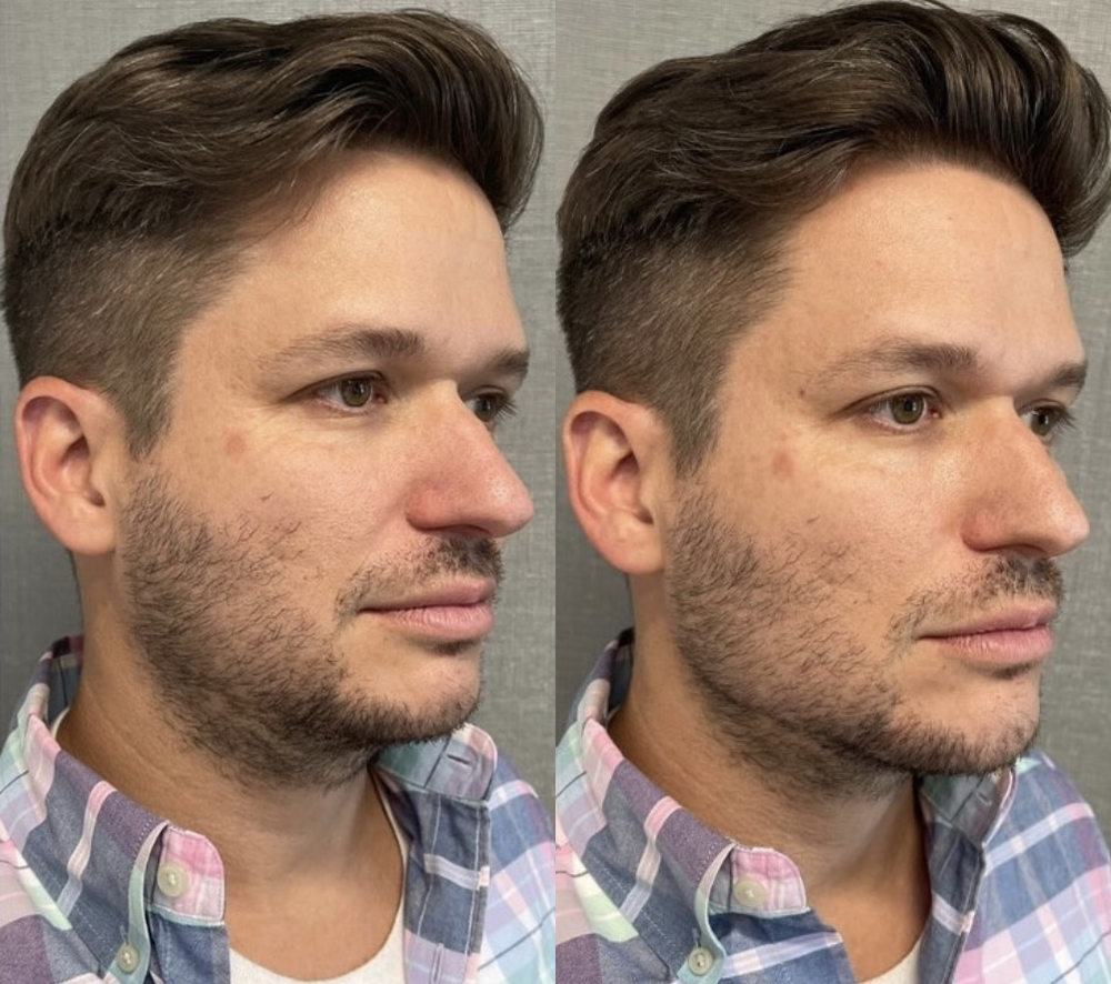 Male Facial Contouring Before and After Photo by Dr. James Y. Wang of Metropolis Dermatology in Los Angeles, CA