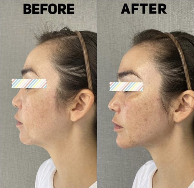 Female Facial Contouring Before and After Photo by Dr. James Y. Wang of Metropolis Dermatology in Los Angeles, CA