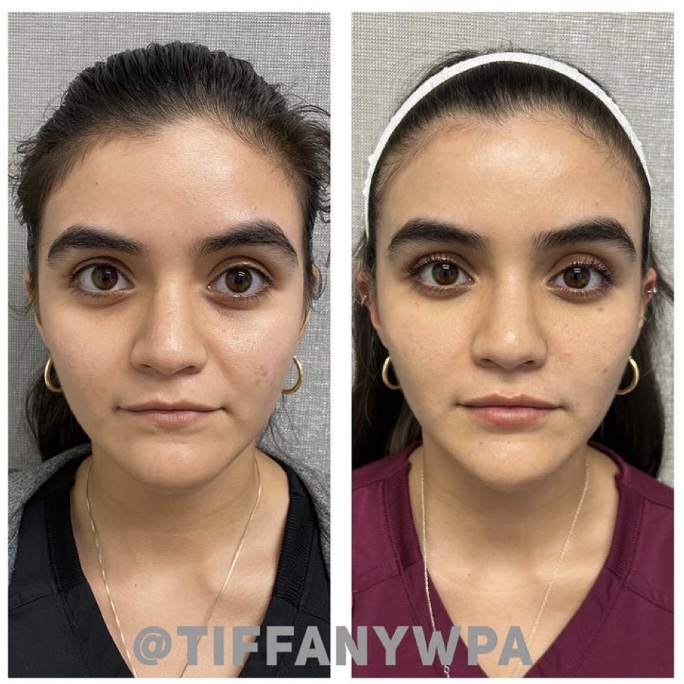 Lip Filler, Under Eye PRP, Sculptra and RF Microneedling Before and After Photo by Metropolis Dermatology in Los Angeles, CA