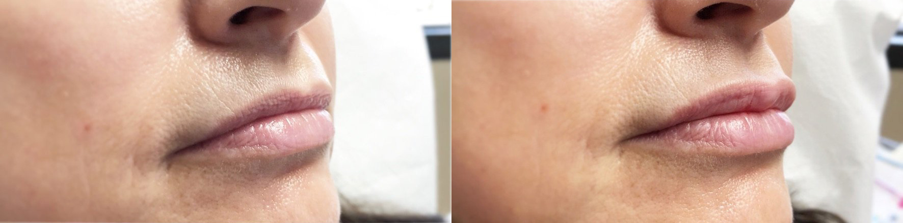 Lip Filler Before and After Photo by Dr. James Y. Wang of Metropolis Dermatology in Los Angeles, CA