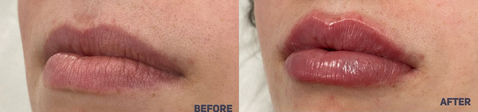 Lip Filler Before and After Photo by Dr. James Y. Wang of Metropolis Dermatology in Los Angeles, CA