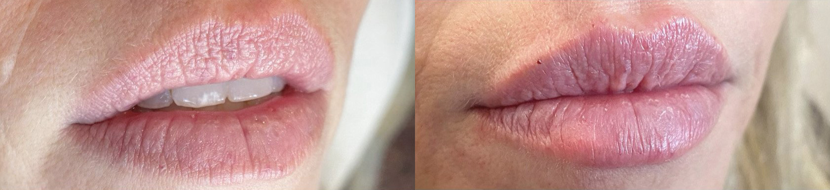 Lip Filler Before and After Photo by Dr. James Y. Wang of Metropolis Dermatology in Los Angeles, CA