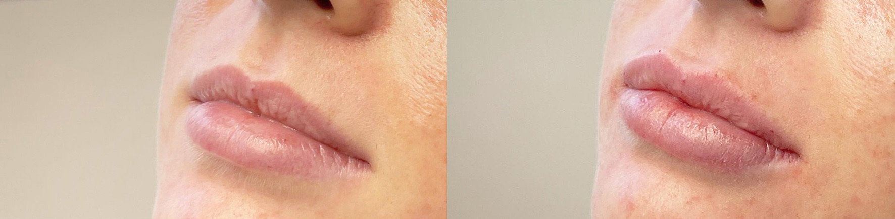 Lip Filler Before and After Photo by Dr. James Y. Wang of Metropolis Dermatology in Los Angeles, CA