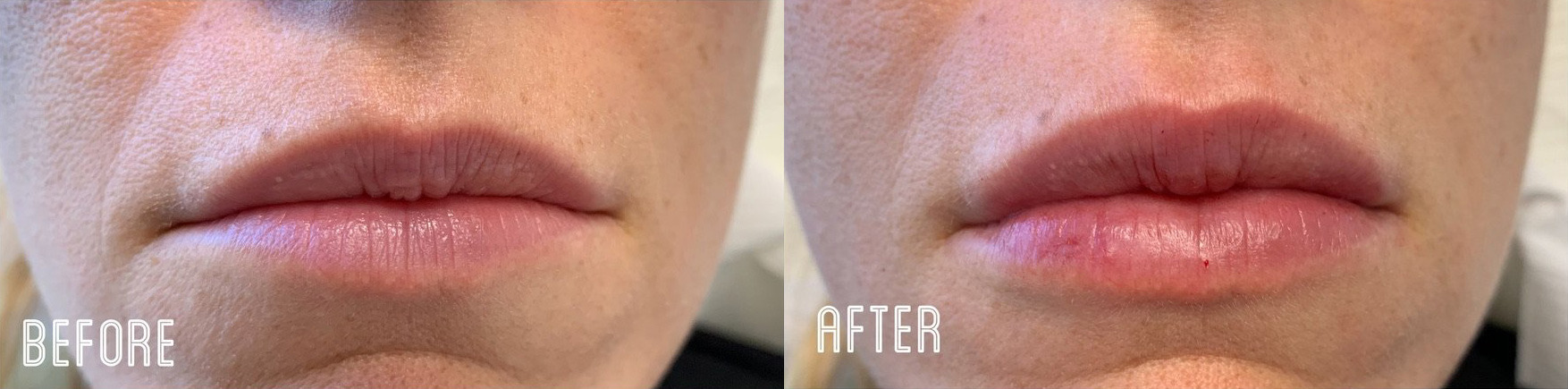 Lip Filler Before and After Photo by Dr. James Y. Wang of Metropolis Dermatology in Los Angeles, CA