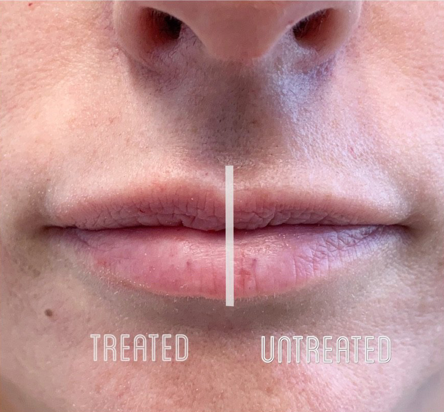 Lip Filler Before and After Photo by Dr. James Y. Wang of Metropolis Dermatology in Los Angeles, CA