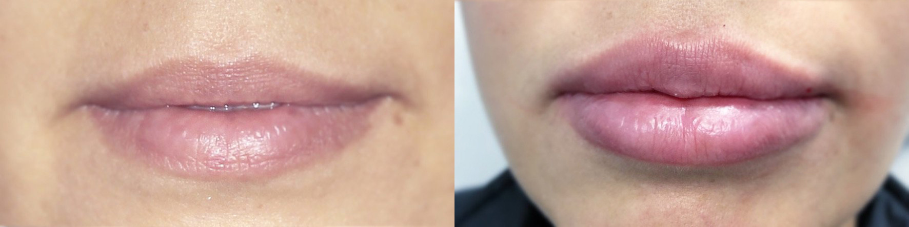 Lip Filler Before and After Photo by Dr. James Y. Wang of Metropolis Dermatology in Los Angeles, CA