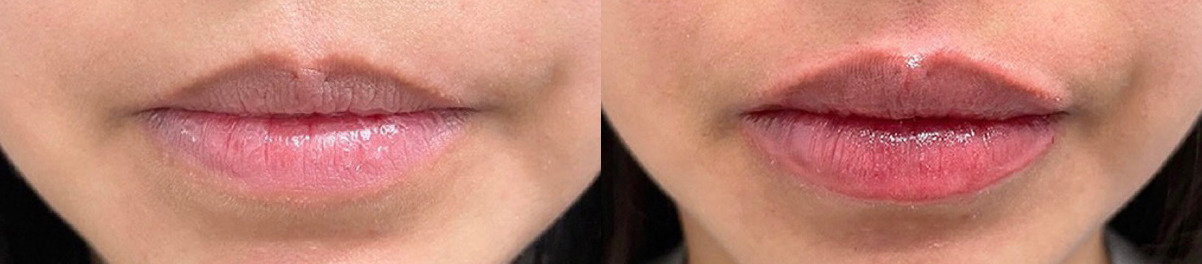 Lip Filler Before and After Photo by Dr. James Y. Wang of Metropolis Dermatology in Los Angeles, CA