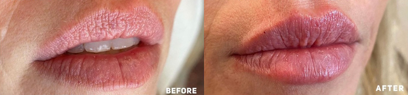 Lip Filler Before and After Photo by Dr. James Y. Wang of Metropolis Dermatology in Los Angeles, CA