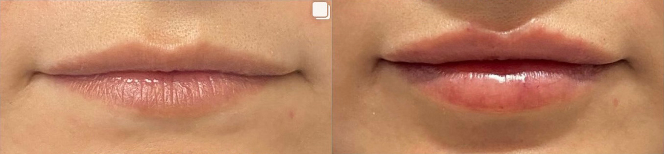 Lip Filler Before and After Photo by Dr. James Y. Wang of Metropolis Dermatology in Los Angeles, CA