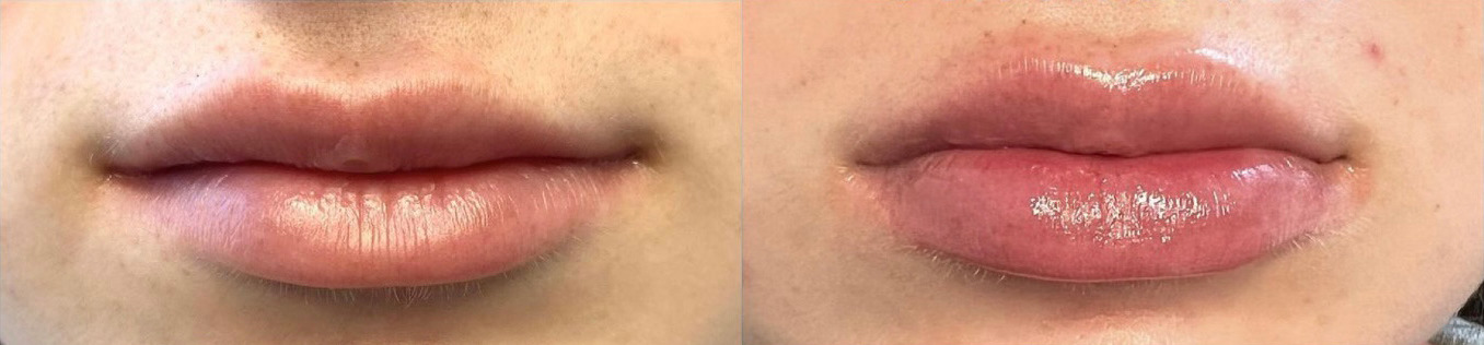 Lip Filler Before and After Photo by Dr. James Y. Wang of Metropolis Dermatology in Los Angeles, CA