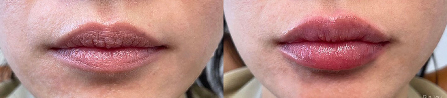 Lip Filler Before and After Photo by Dr. James Y. Wang of Metropolis Dermatology in Los Angeles, CA