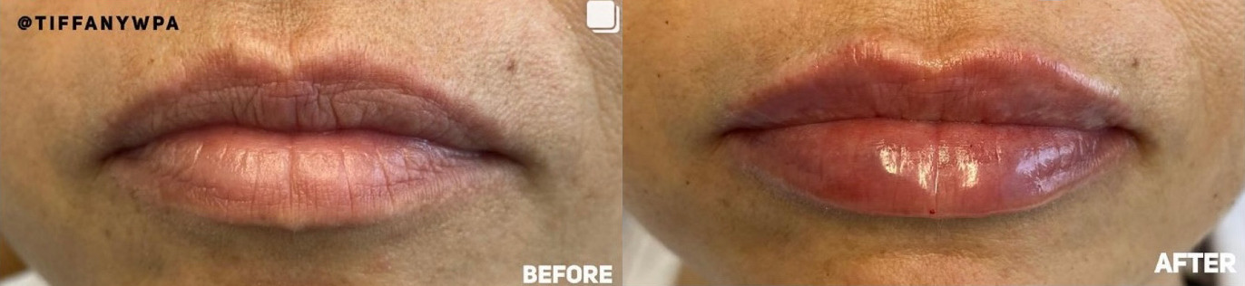 Lip Filler Before and After Photo by Dr. James Y. Wang of Metropolis Dermatology in Los Angeles, CA