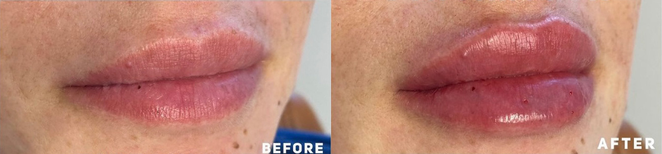 Lip Filler Before and After Photo by Dr. James Y. Wang of Metropolis Dermatology in Los Angeles, CA