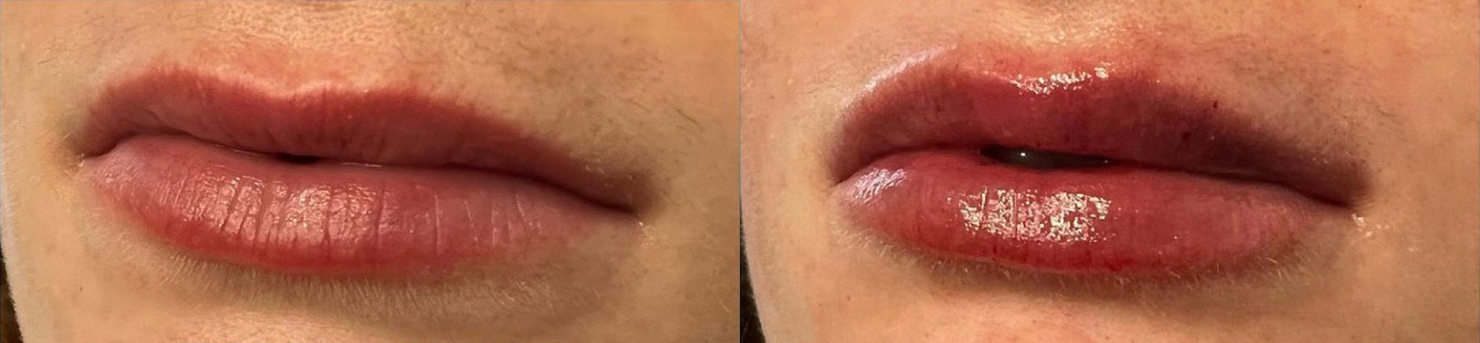 Lip Filler Before and After Photo by Dr. James Y. Wang of Metropolis Dermatology in Los Angeles, CA