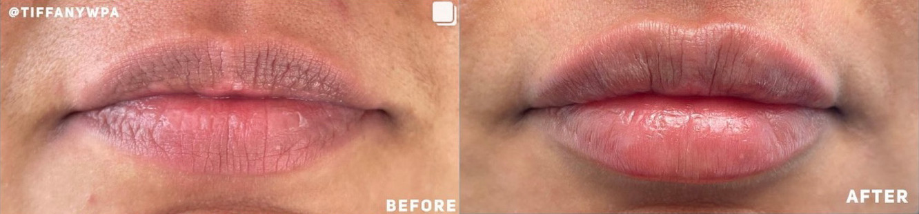 Lip Filler Before and After Photo by Dr. James Y. Wang of Metropolis Dermatology in Los Angeles, CA