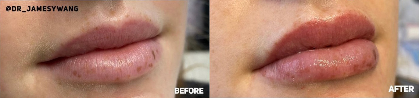 Lip Filler Before and After Photo by Dr. James Y. Wang of Metropolis Dermatology in Los Angeles, CA