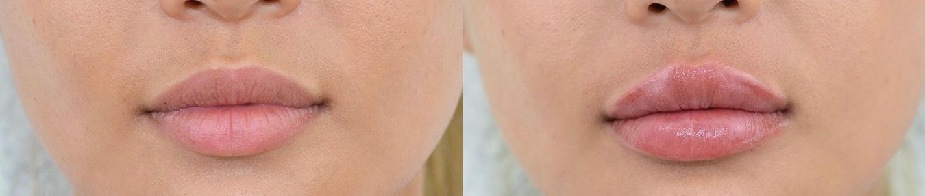 Lip Filler Before and After Photo by Dr. James Y. Wang of Metropolis Dermatology in Los Angeles, CA