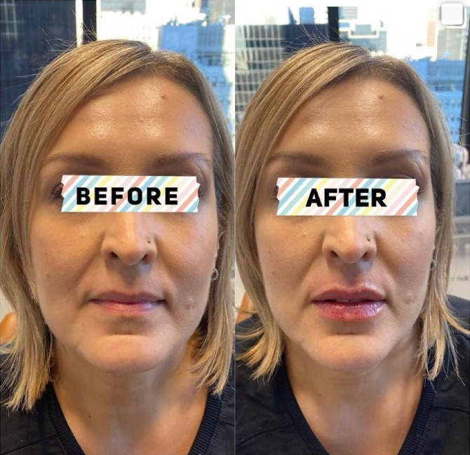 Lip Filler Before and After Photo by Dr. James Y. Wang of Metropolis Dermatology in Los Angeles, CA