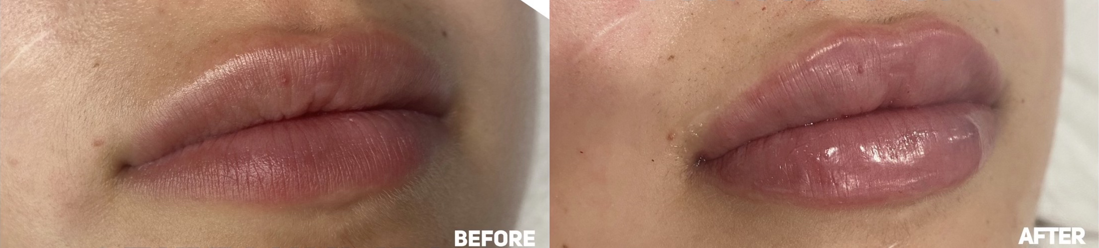 Lip Filler Before and After Photo by Dr. James Y. Wang of Metropolis Dermatology in Los Angeles, CA