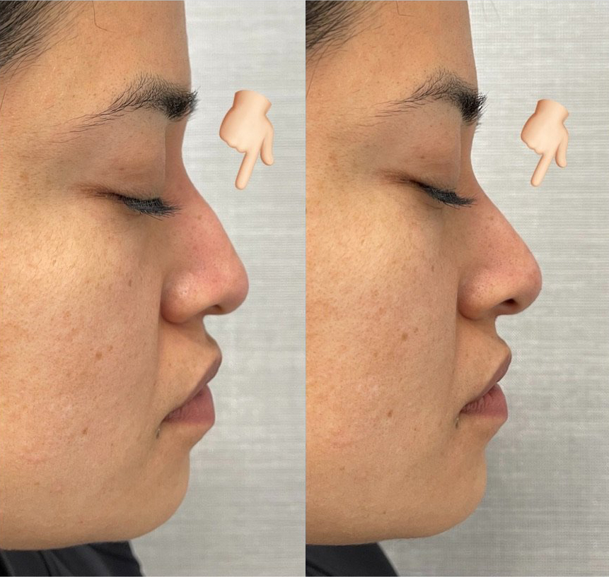 Liquid Rhinoplasty Before and After Photo by Dr. James Y. Wang of Metropolis Dermatology in Los Angeles, CA