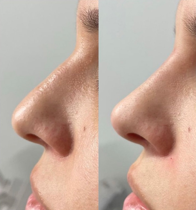 Liquid Rhinoplasty Before and After Photo by Dr. James Y. Wang of Metropolis Dermatology in Los Angeles, CA