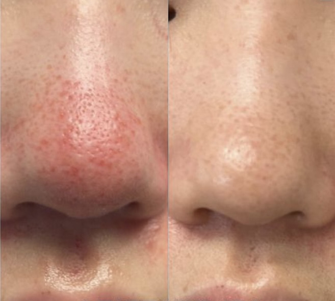 Rosacea Treatment Before and After Photo by Dr. James Y. Wang of Metropolis Dermatology in Los Angeles, CA