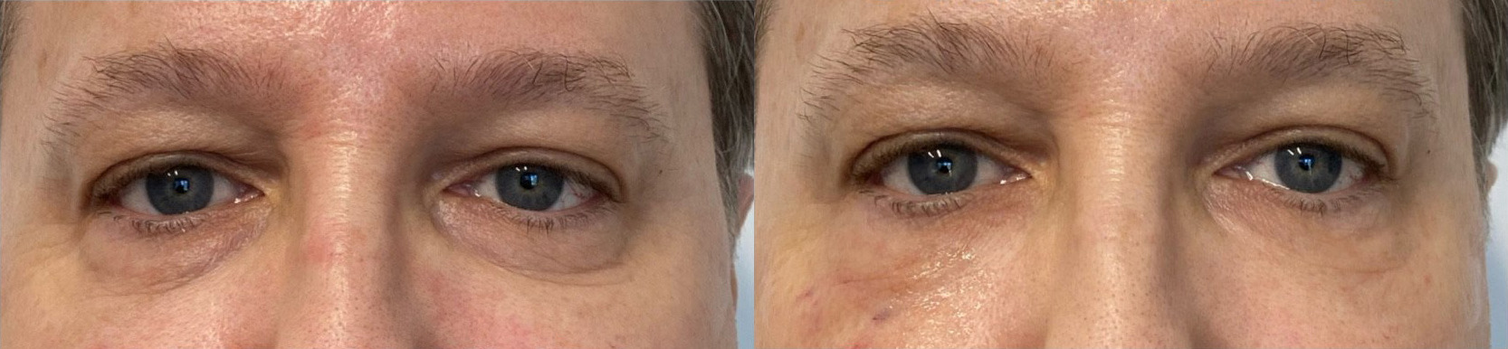 Under Eye PRP Before and After Photo by Dr. James Y. Wang of Metropolis Dermatology in Los Angeles, CA