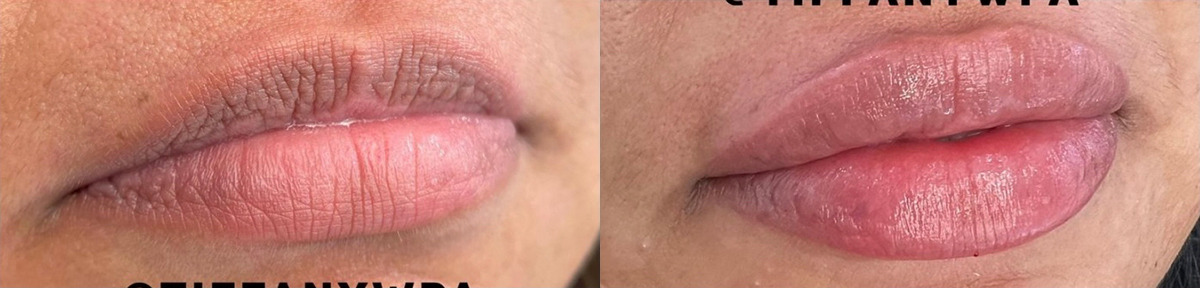 Lip Filler Before and After Photo by Dr. James Y. Wang of Metropolis Dermatology in Los Angeles, CA