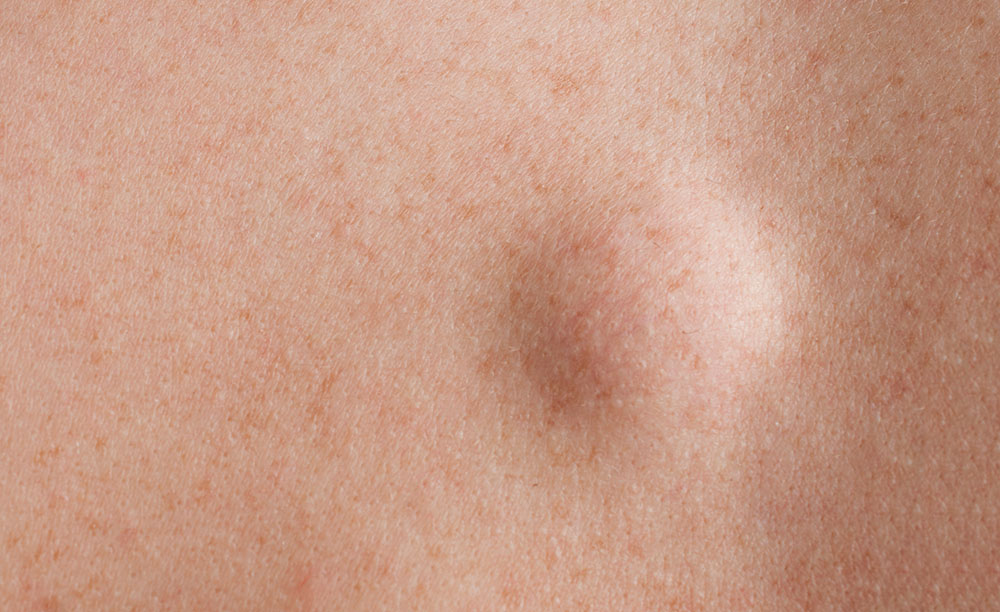 Round lipoma close up shot on the back of a caucasian man