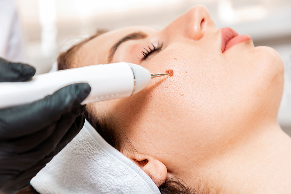 Surgeon using a laser device for removing mole