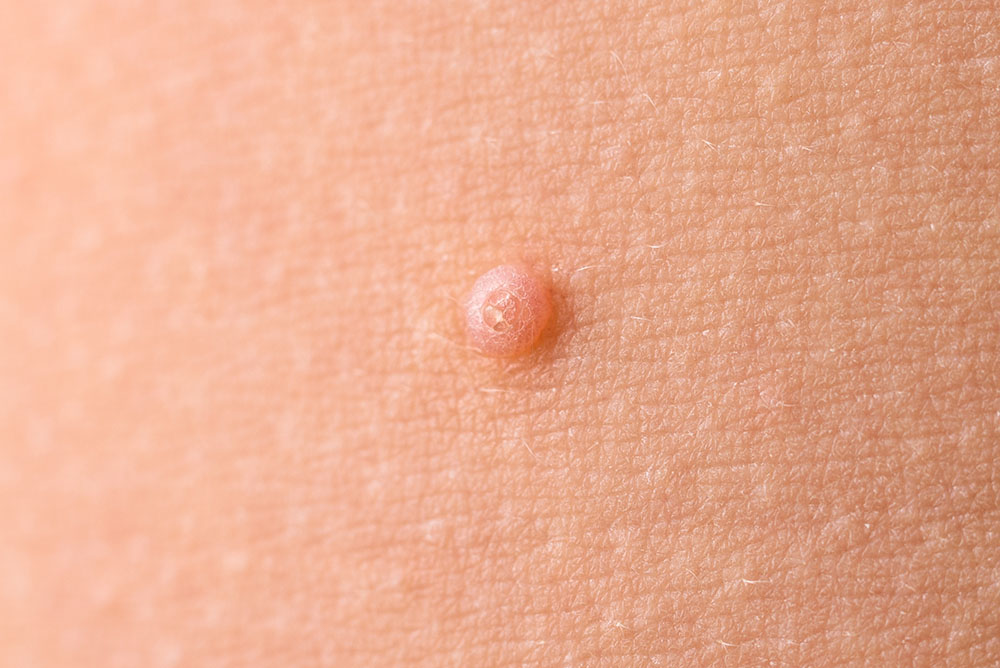 Detail of a molluscum contagiosum nodule 