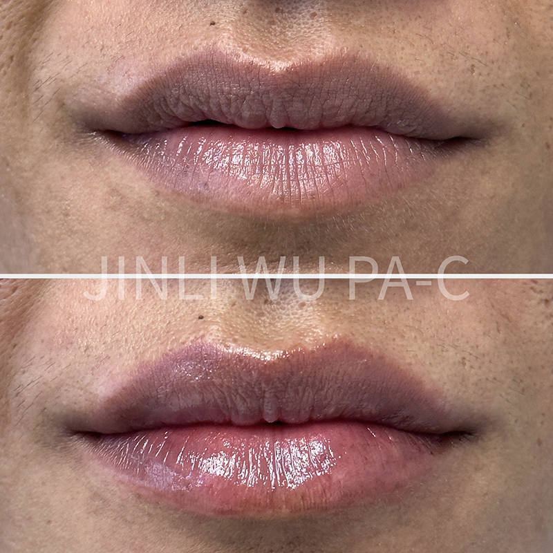 Lip Filler Before and After Photo by Dr. James Y. Wang of Metropolis Dermatology in Los Angeles, CA