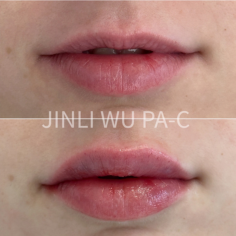 Lip Filler Before and After Photo by Dr. James Y. Wang of Metropolis Dermatology in Los Angeles, CA