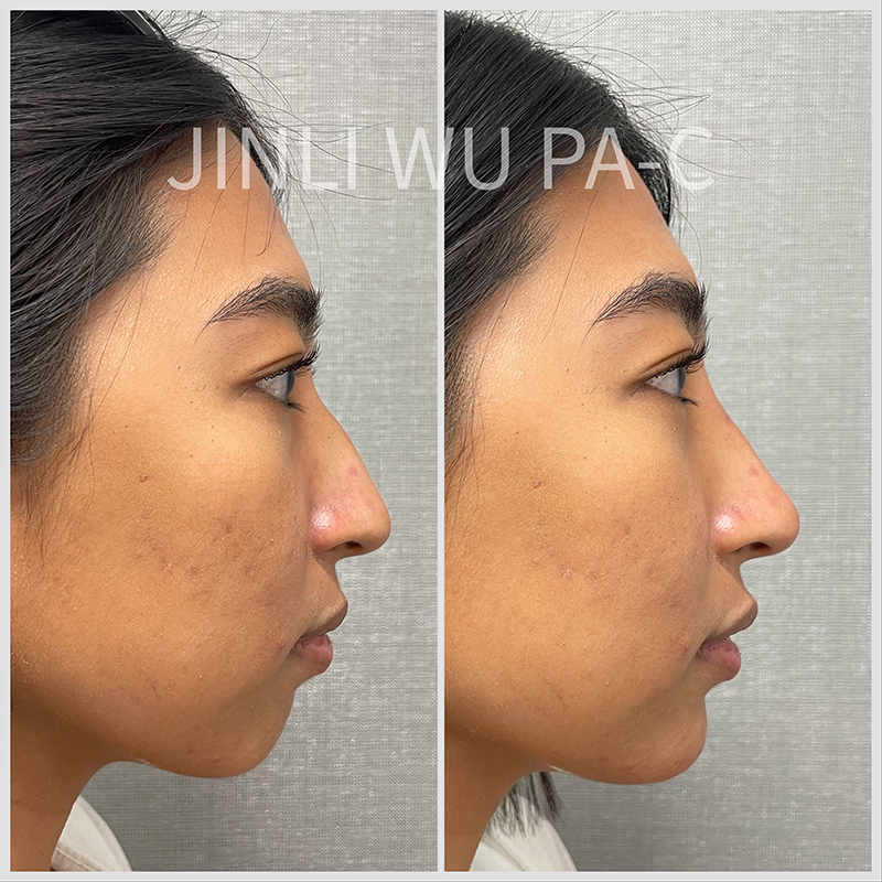 Liquid Rhinoplasty Before and After Photo by Dr. James Y. Wang of Metropolis Dermatology in Los Angeles, CA