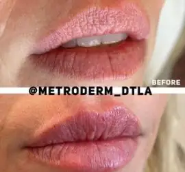 Before & After Gallery Metropolis Dermatology Los Angeles