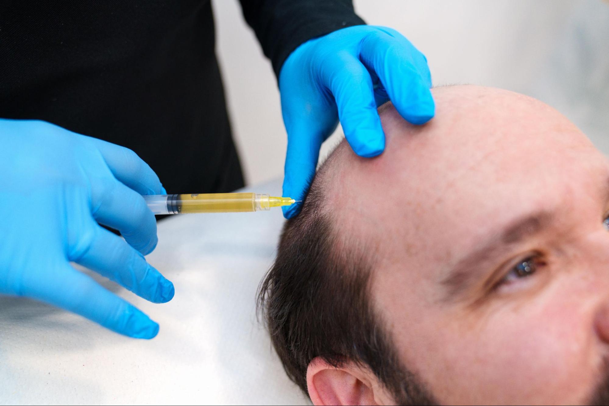 PRP hair treatment being applied to the scalp to stimulate hair growth using growth factors and stem cells.