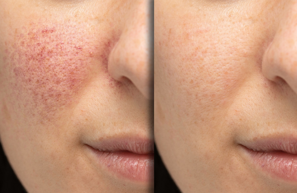 Acne Scarring Metropolis Dermatology Los Angeles