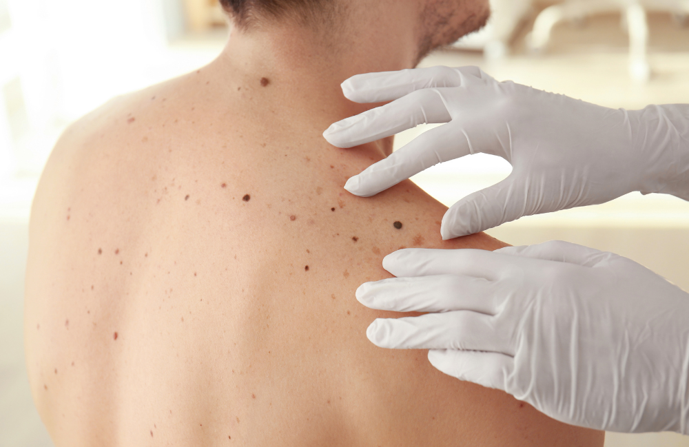 Acne Scarring Metropolis Dermatology Los Angeles