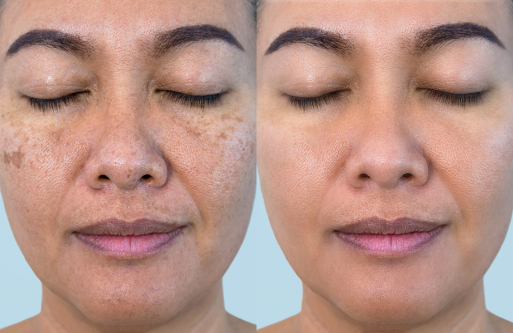 Acne Scarring Metropolis Dermatology Los Angeles