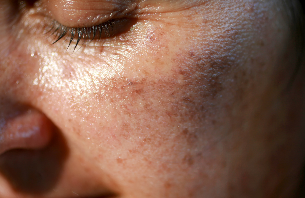 Acne Scarring Metropolis Dermatology Los Angeles