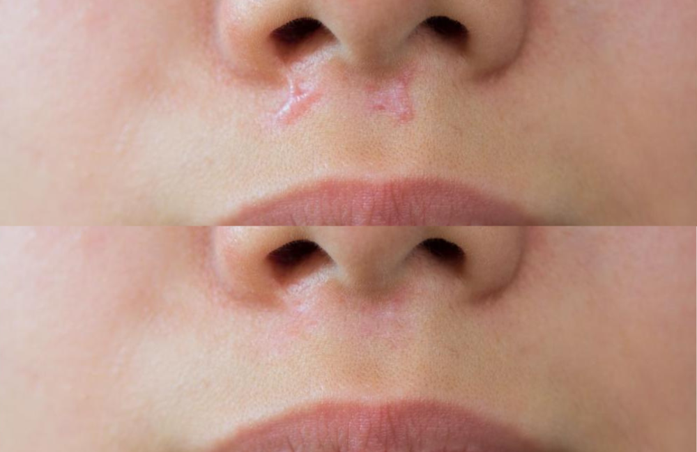 Acne Scarring Metropolis Dermatology Los Angeles