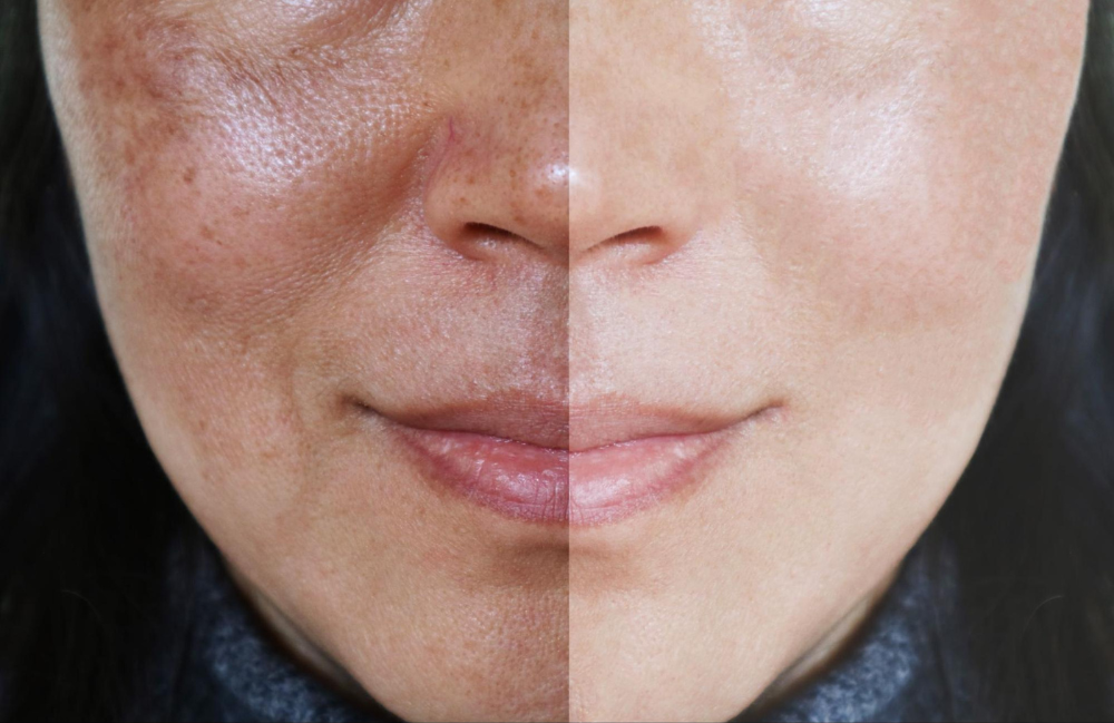 Acne Scarring Metropolis Dermatology Los Angeles