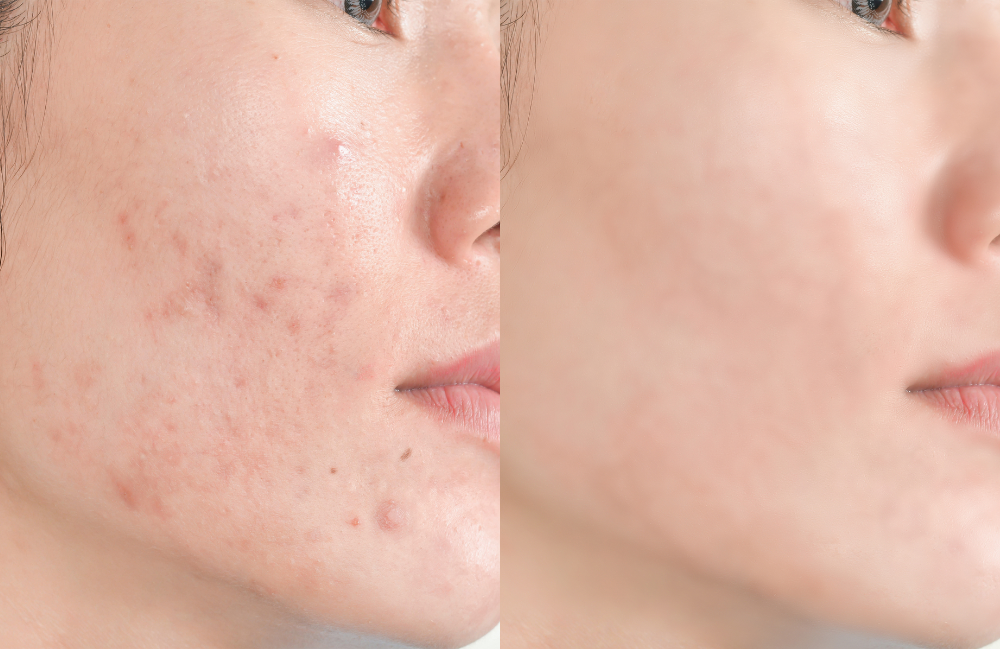 Acne Scarring Metropolis Dermatology Los Angeles