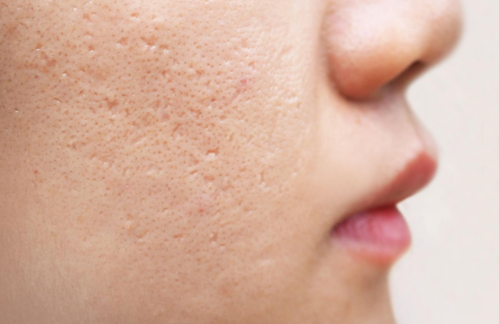 Acne Scarring Metropolis Dermatology Los Angeles